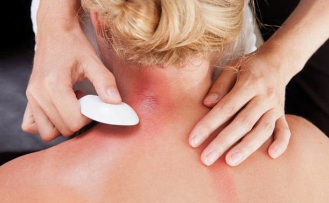 Bỏ túi các biện pháp đánh gió (đánh cảm) thông dụng nhất