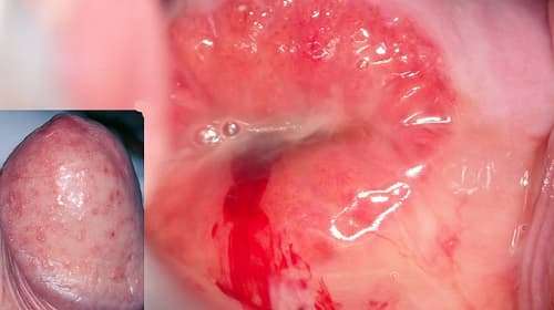 Bệnh Chlamydia - Căn bệnh lây nhiễm qua đường tình dục