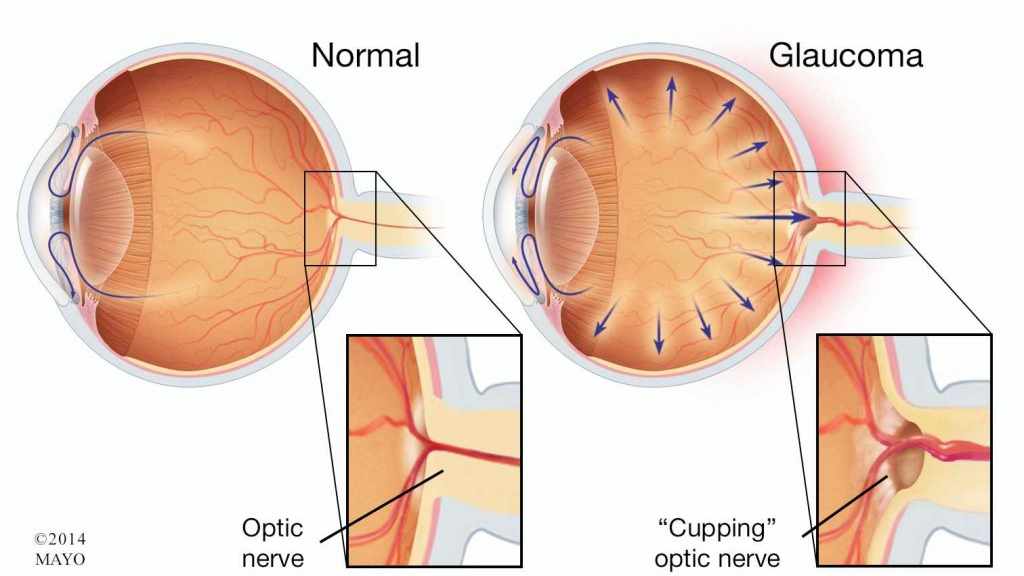 Mổ đục thủy tinh thể có nguy cơ dẫn đến Glaucoma