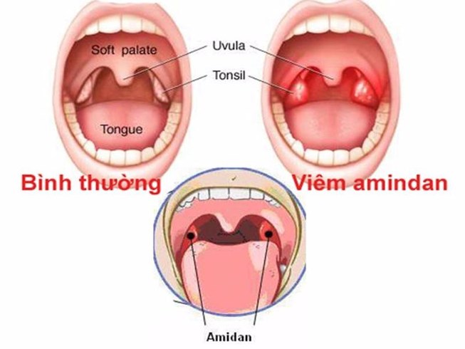 Lúc nào cần cắt Amidan - Lời khuyên của Bs. Phạm Khắc Trí