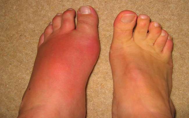Cách chăm sóc bệnh nhân Gout tại nhà