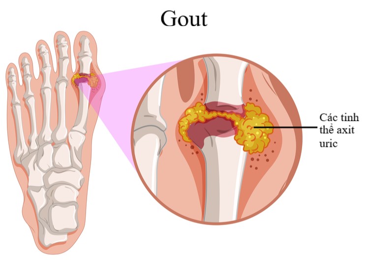 Cách dùng thuốc và chế độ ăn cho người bị bệnh gout