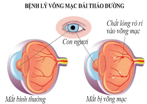 Biến chứng võng mạc của bệnh tiểu đường