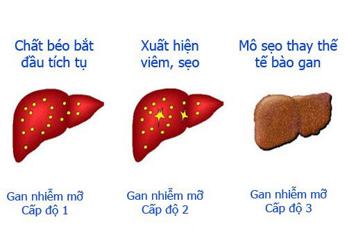 Bệnh gan nhiễm mỡ có nguy hiểm không?