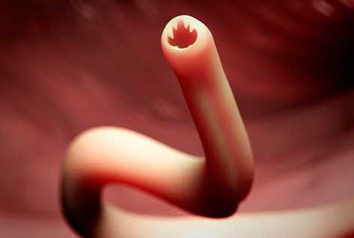 Bệnh Giun móc và tác hại của Giun móc