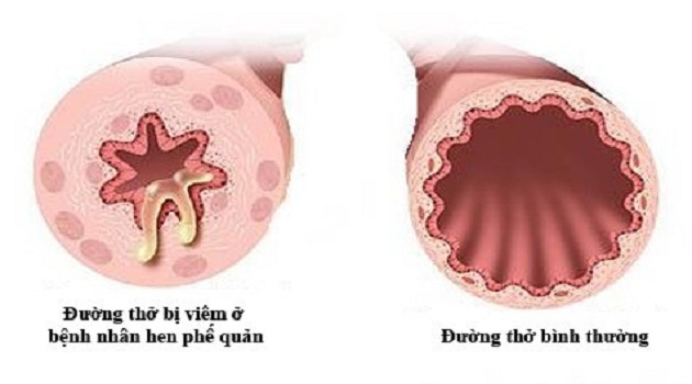 Bệnh hen phế quản là gì? Triệu chứng và cách xử trí cơn hen phế quản