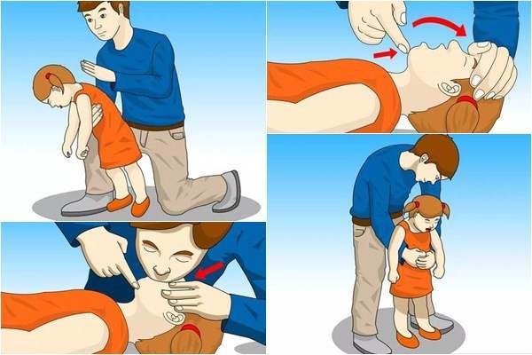 Học ngay cách sơ cứu này khi trẻ bị sặc (hóc dị vật)