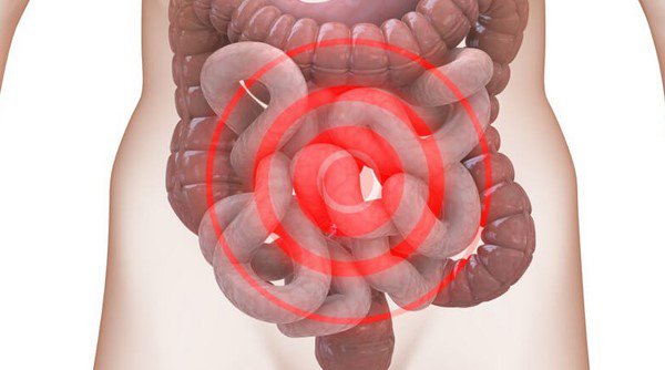 Hội chứng ruột kích thích là gì? Điều trị như nào?