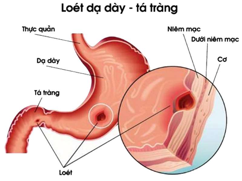 Muốn điều trị tốt bệnh loét hành - tá tràng cần phải làm gì?