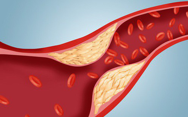 Biện pháp phòng ngừa Mỡ trong máu cao