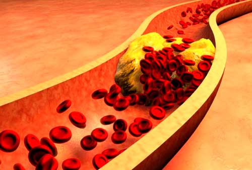 PGS Đặng Văn Phước chia sẻ về Mỡ trong máu