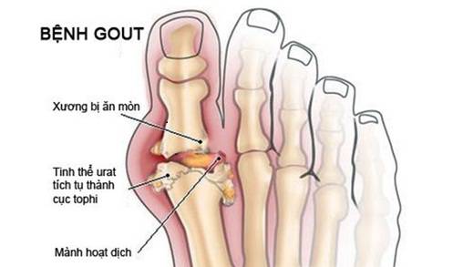 Bệnh gout được điều trị như thế nào?