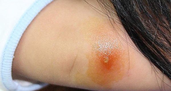 Những biện pháp phòng tránh nhiễm trùng