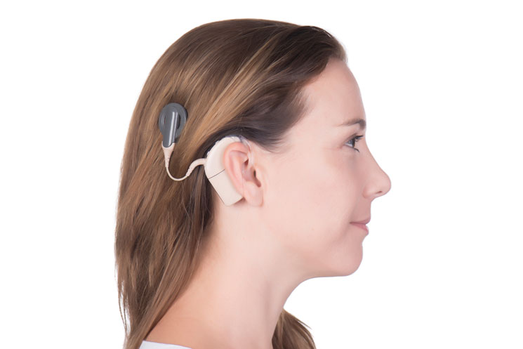 Chữa điếc bằng cách cấy ốc tai điện tử