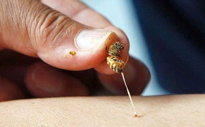Cách xử trí khi bị ong châm