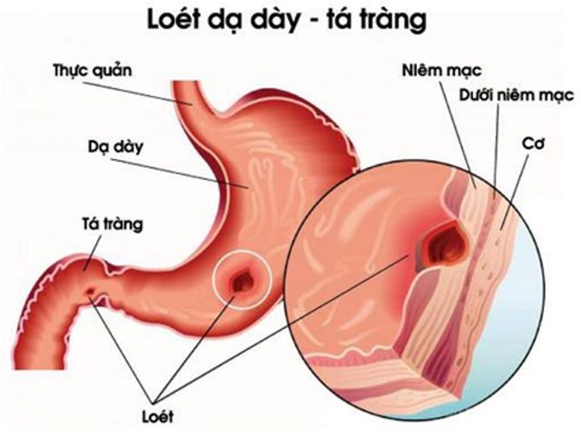 Dạ dày, viêm loét dạ dày nguyên nhân do đâu?