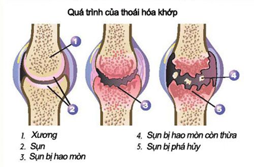 Thoái hóa khớp, nguyên nhân, triệu chứng và cách điều trị