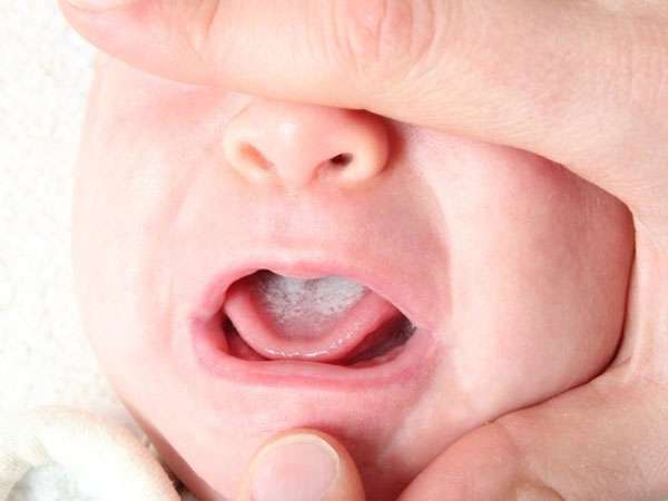Trẻ bị đau miệng là bệnh gì có nguy hiểm không?