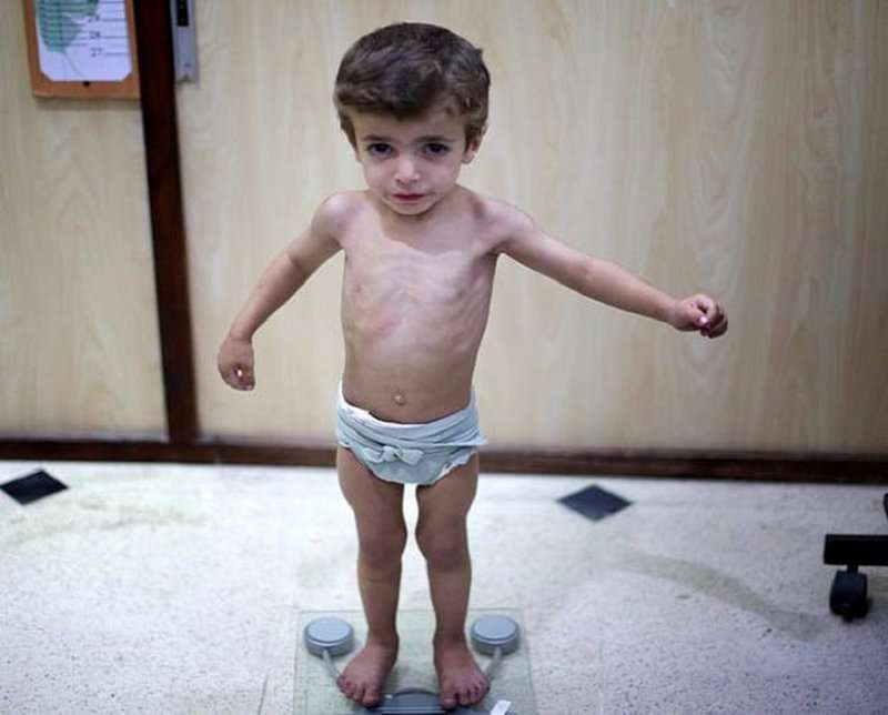 Trẻ bị suy dinh dưỡng có nên dùng Kiện tỳ tiêu thực không?