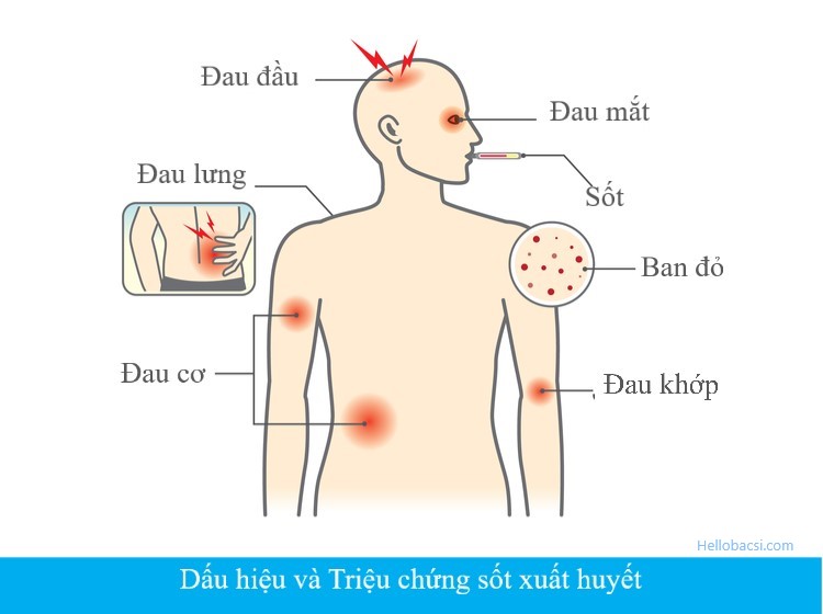 Bệnh sốt xuất huyết ở người lớn và trẻ em