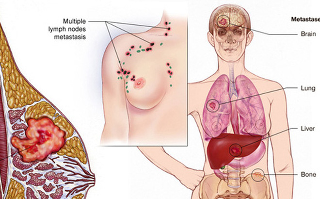 Tự kiểm tra để phát hiện sớm ung thư vú