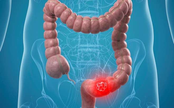 Một số thực phẩm giúp phòng ngừa ung thư kết ruột