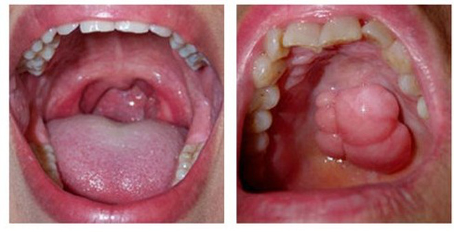 Cách phát hiện sớm Ung thư khoang miệng