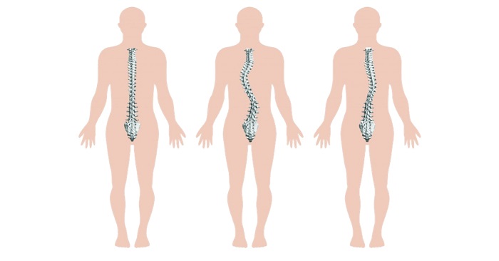 Vẹo cột sống và phương pháp phòng ngừa cho trẻ