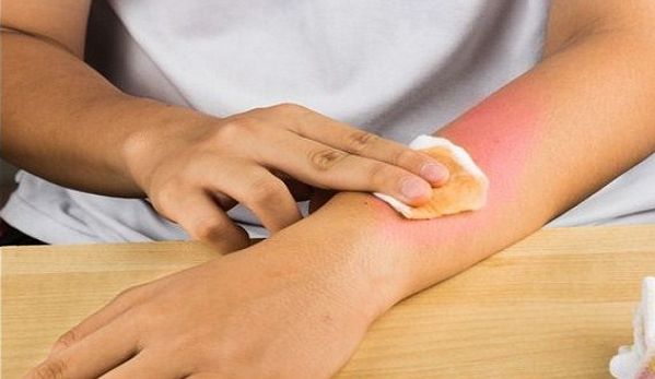 Nguyên nhân và xử lý vết bỏng ngoài da