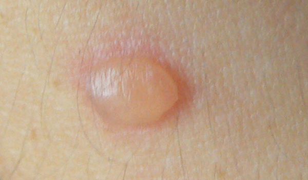 Vết phồng trên da