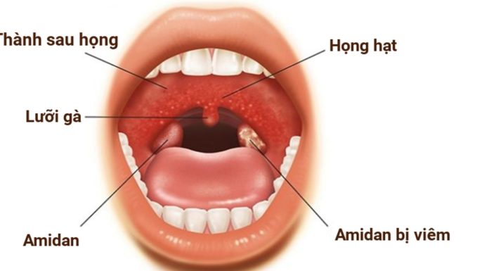 Điều trị viêm amidan bằng bài thuốc cát cánh thang
