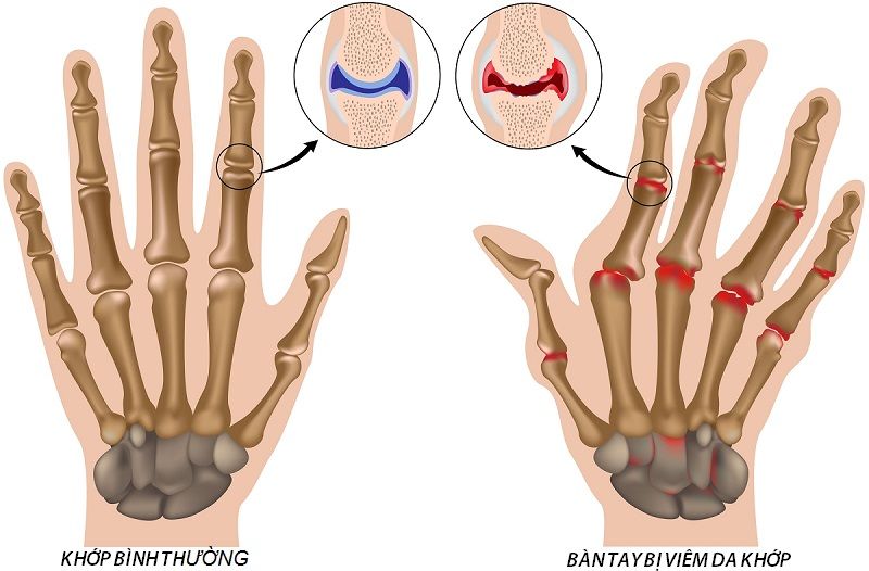 BS Lê Anh Thư Bệnh viện Chợ Rẫy chia sẻ cách điều trị viêm khớp dạng thấp