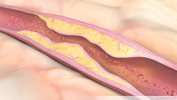 Xơ cứng động mạch